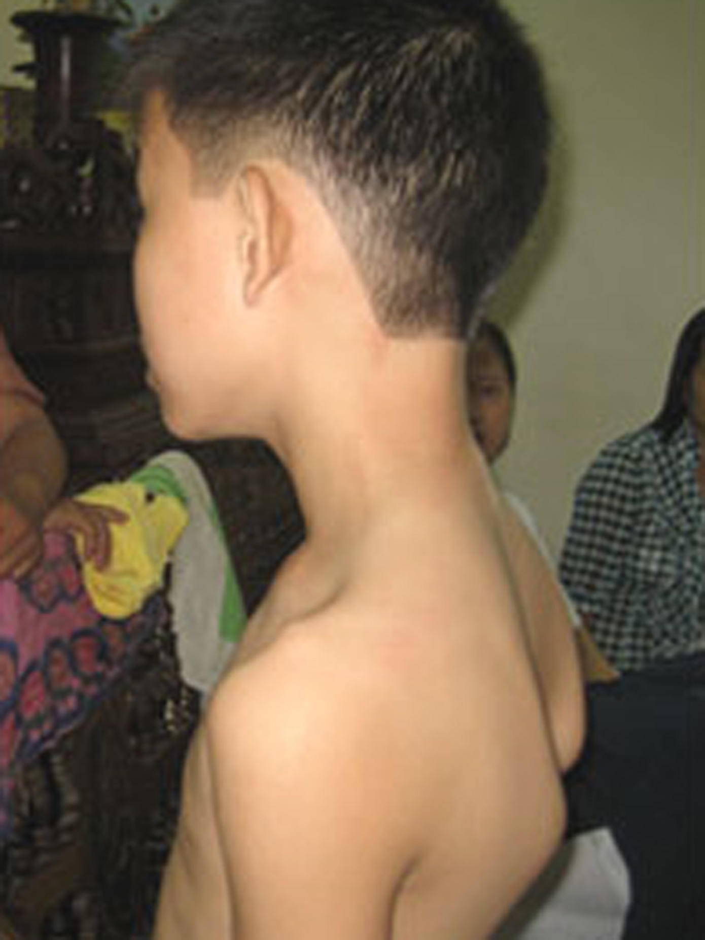 Hai xương bả vai gồ cao mặc dù N.N.Hải để thõng hai tay ở vị trí bình thường. Ảnh: L.Anh (Thanh Niên)