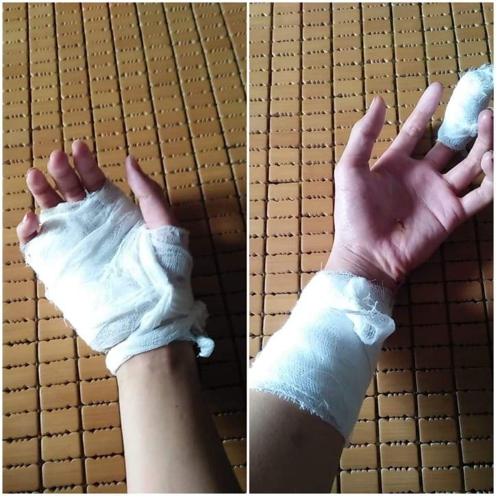 Xô xát trước lớp học, nam sinh phải khâu 30 mũi ảnh 1