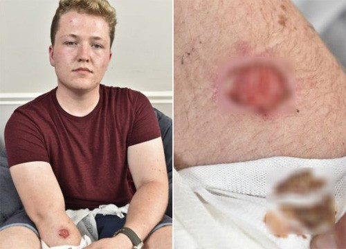 Một người dùng bị bỏng do iPhone 5 nóng bất thường ảnh 1