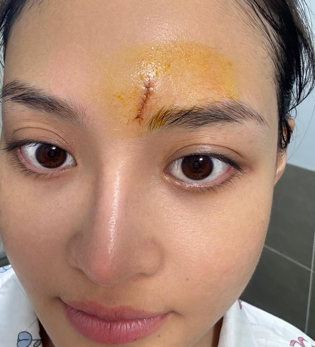 Thùy Anh bị chấn thương trong quá trình quay phim.