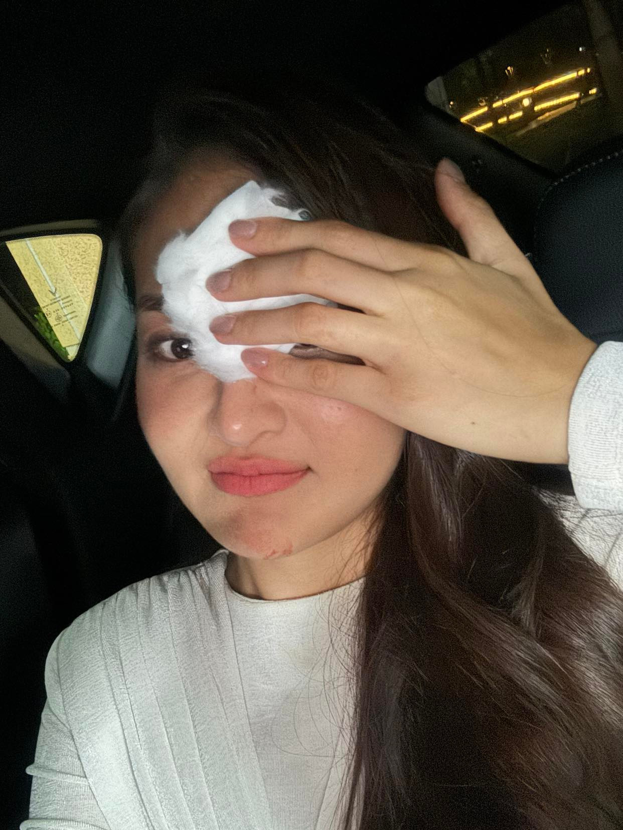 Hình ảnh vết thương trên trán của Thùy Anh. Ảnh: NVCC.