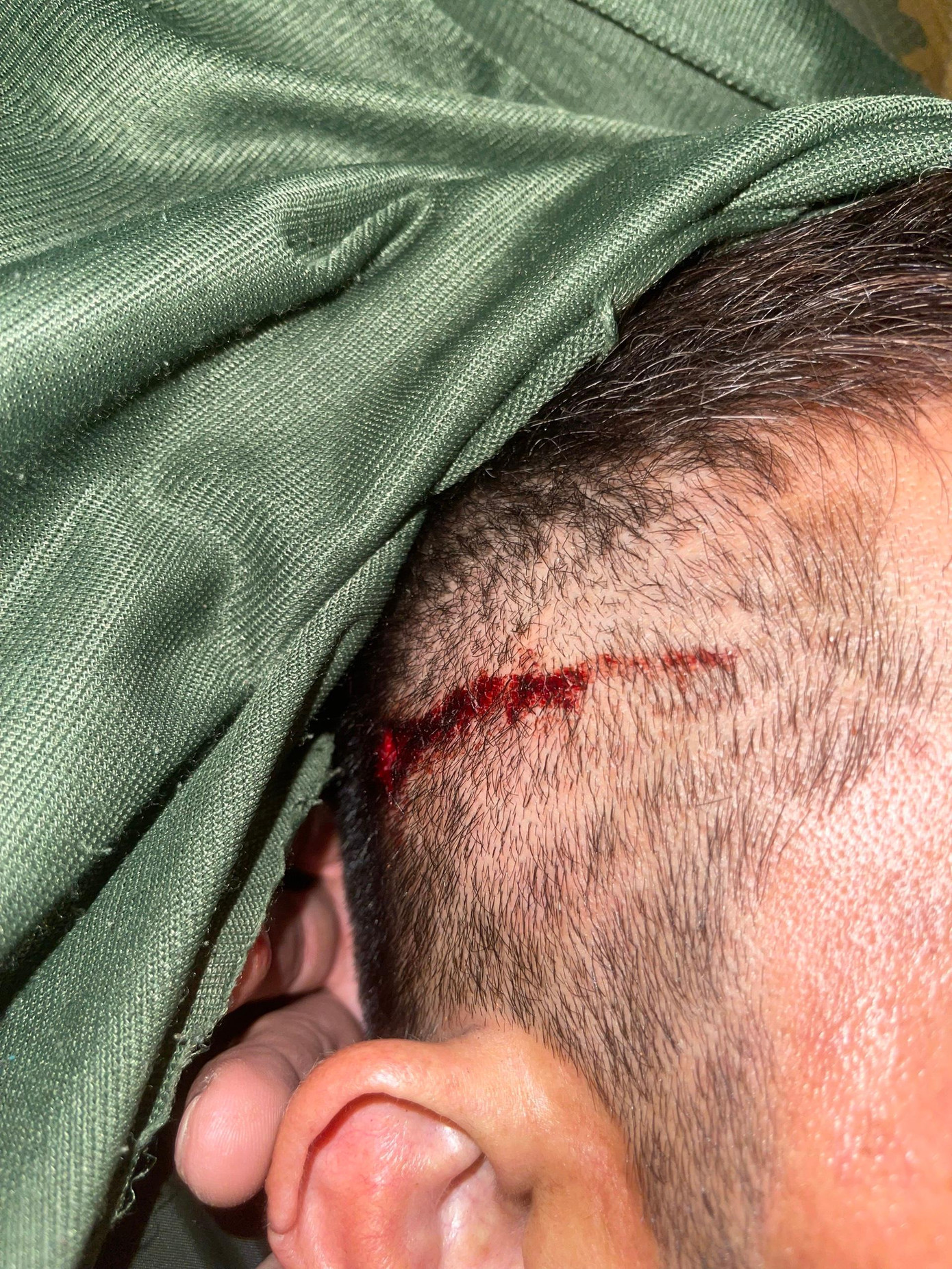 Vết thương ở vùng đầu nam ca sĩ. Vết thương ở vùng đầu nam ca sĩ.