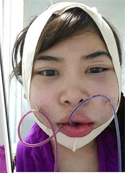 Những ống dẫn được bác sĩ gắn vào khuôn mặt của Dora để giúp giảm sưng tấy