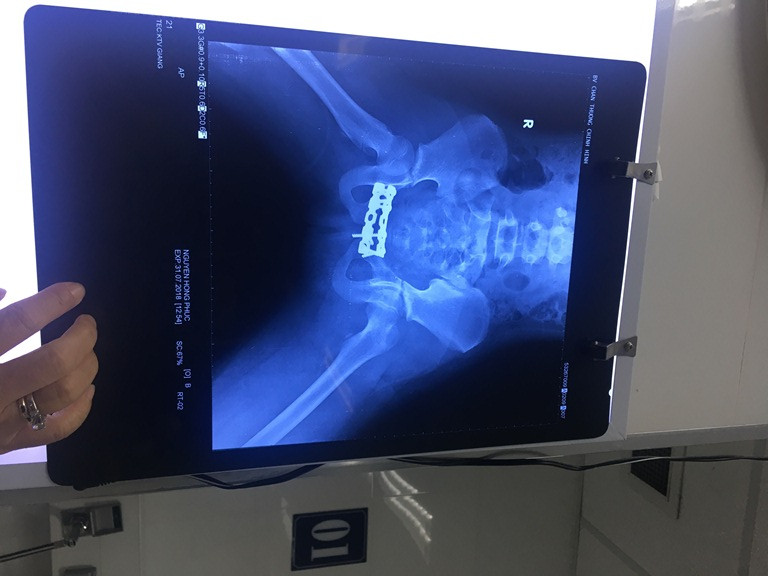 Xót xa bé 10 tuổi bị đứt lìa chân do tai nạn với xe tải ảnh 2