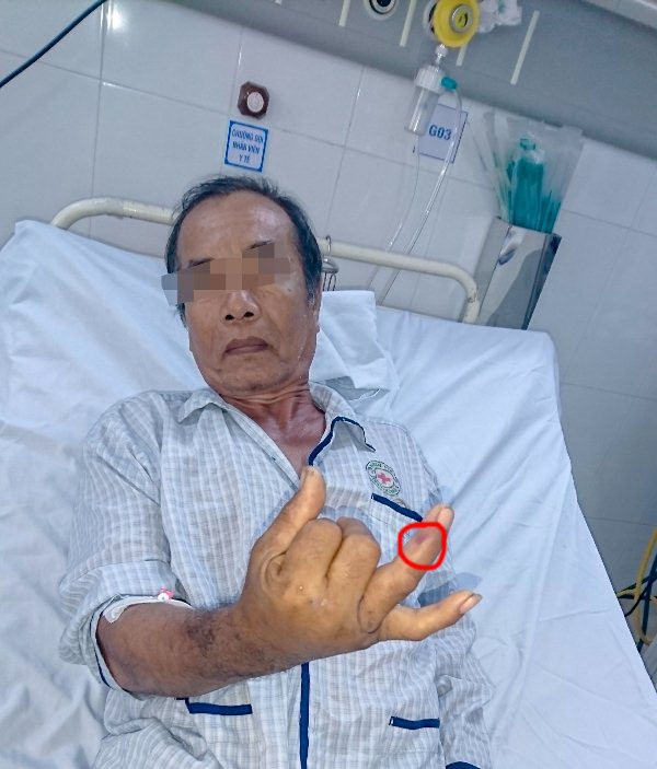 Nhiều người nhập viện do rắn lục đuôi đỏ cắn ảnh 1