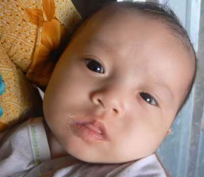 Cháu Minh mắt trái bị bệnh nhỏ hơn mắt phải. Ảnh: TÙNG HUYÊN