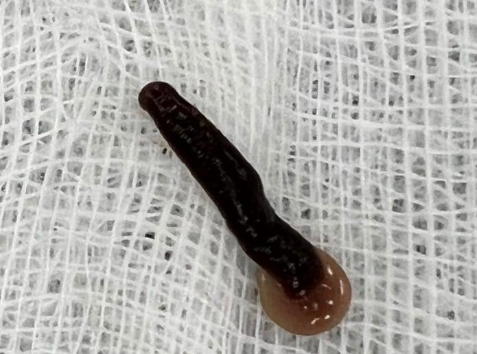 Con đỉa được gắp ra khỏi mũi của bệnh nhân