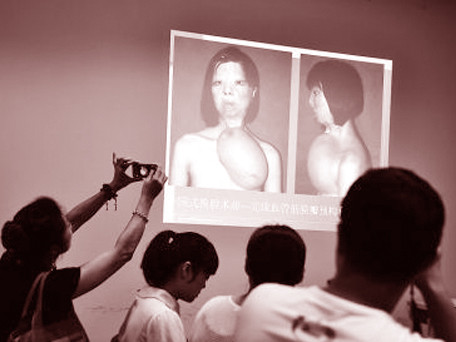 Khuôn mặt mới được cấy lên phía ngực trái của cô gái 17 tuổi Xu Jianmei