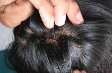 Do cô gái đó đã dùng loại dầu gội không đảm bảo chất lượng, hàng trôi nổi trên thị trường, khi gội không sạch, các hóa chất trong dầu gội tạo ra phản ứng hóa học khiến tóc của cô ấy bốc chá