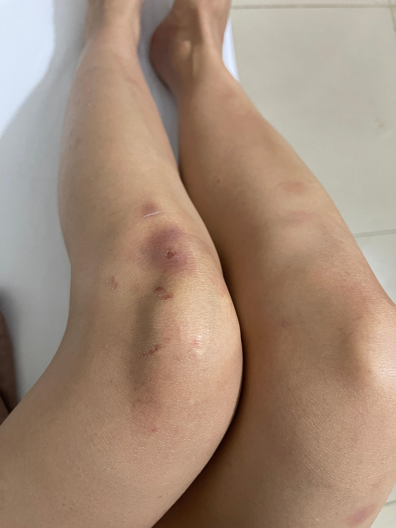 Phần đầu gối bầm tím do các cảnh hành động được Sam tiết lộ.