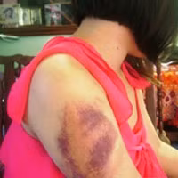 Vết bầm tím sau vụ bạo hành