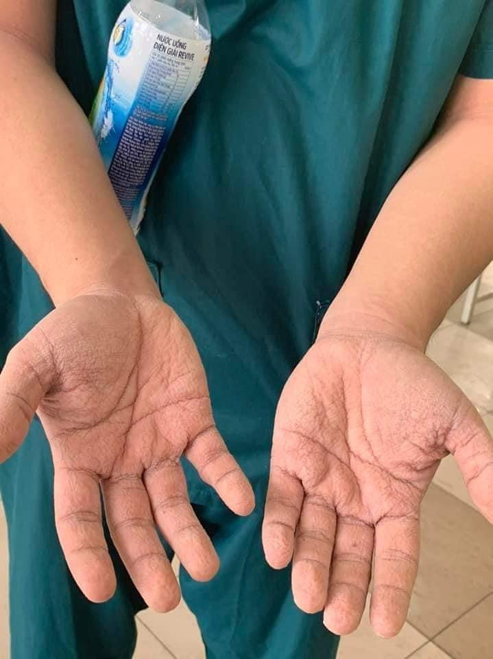 Đôi bàn tay nhăn nheo của 1 bạn sinh viên sau hàng giờ mặc đồ bảo hộ để thực hiện công việc. Ảnh: Internet.