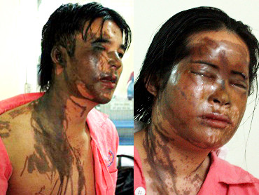 Anh Thược gần như bị mù mắt phải sau khi bị tạt axit vào khuya 27-1 còn chị Luyn - vợ anh chỉ biết khóc khi nhớ lại đêm kinh hoàng