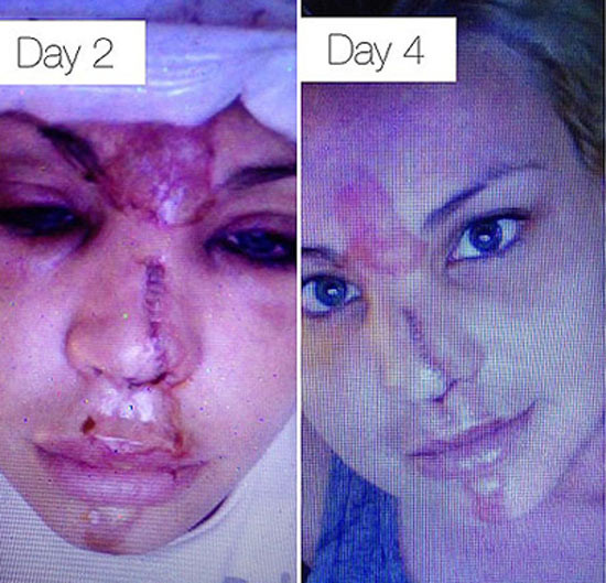 Vụ tai nạn khiến gương mặt Lisa D’Amato trở nên đáng sợ. Vụ tai nạn đã khiến gương mặt Lisa D’Amato trở nên đáng sợ