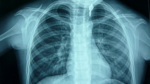 Kết quả chụp phim sáng ngày 28/9 của bé Anh - Ảnh: Vietnamnet.vn. Kết quả chụp phim sáng ngày 28/9 của bé Anh - Ảnh: Thanh Huyền