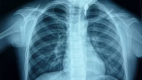 Kết quả chụp phim sáng ngày 28/9 của bé Anh - Ảnh: Thanh Huyền