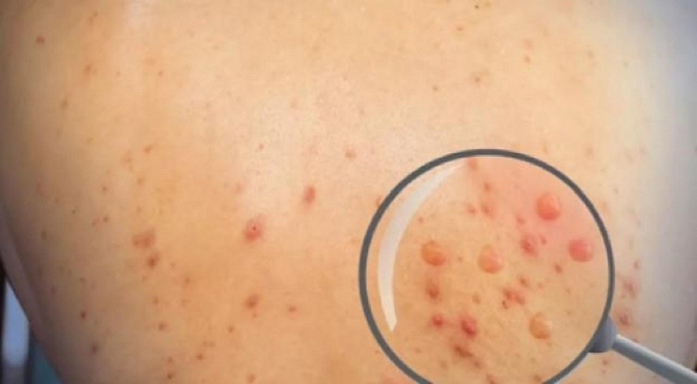 Đắk Lắk phát hiện 1 trường hợp nghi mắc bệnh đầu mùa khỉ. Ảnh minh họa