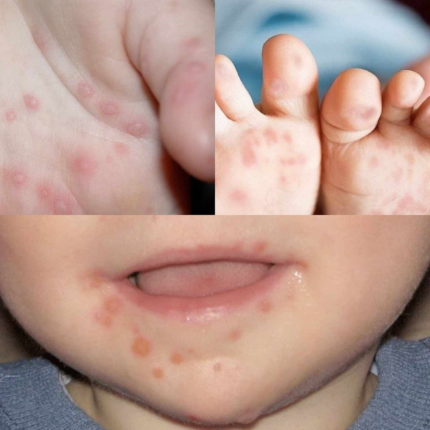 Đắk Lắk vừa ghi nhận thêm 1 trẻ tử vong vì bệnh tay chân miệng. Ảnh minh họa