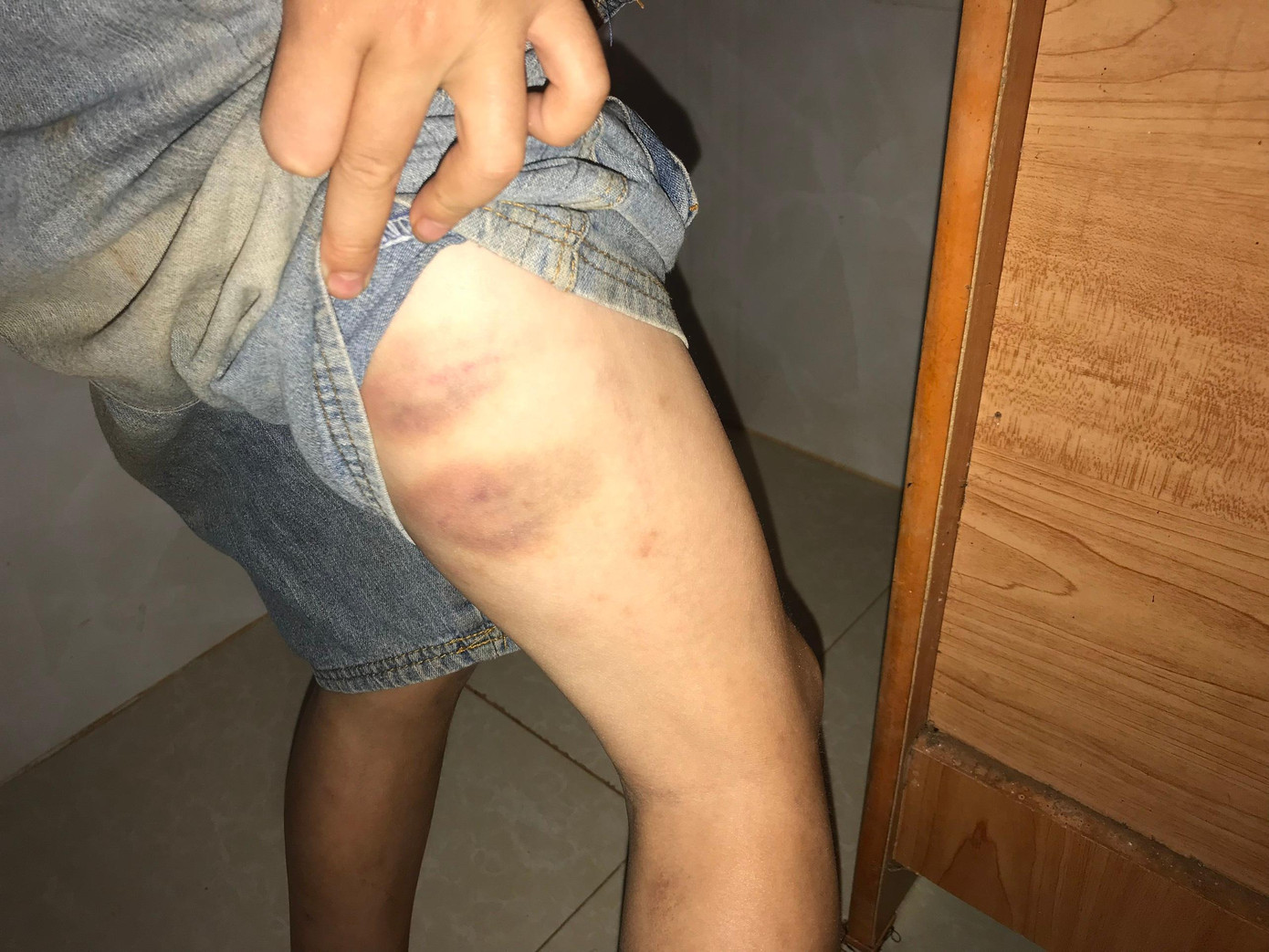 Nhiều vết thương trên chân cháu A. Ảnh gia đình cung cấp