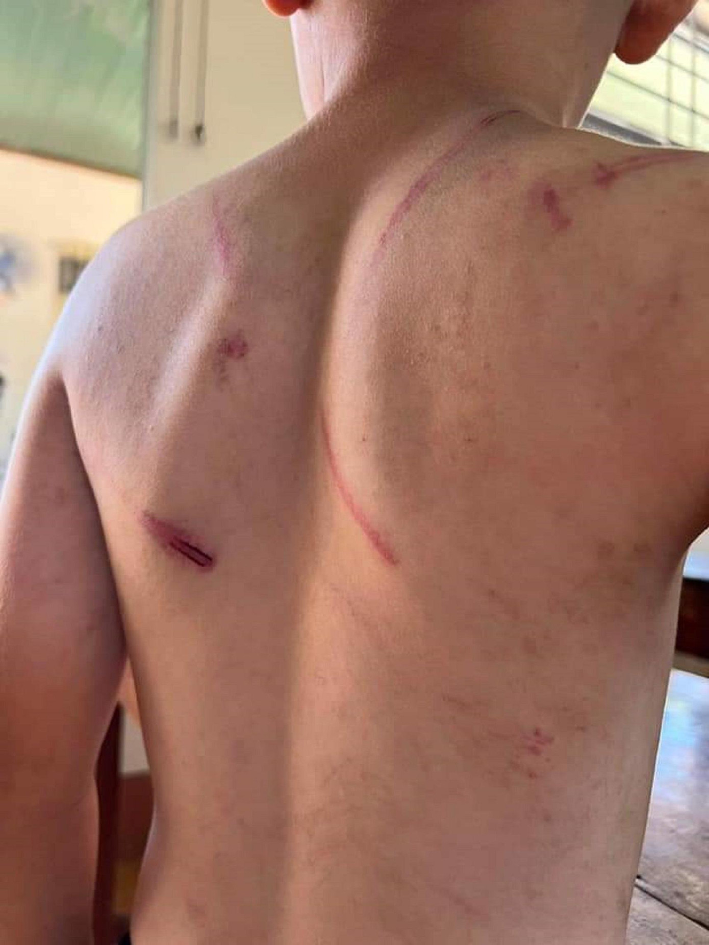 Hình ảnh cháu A. bị thương tích đầy người