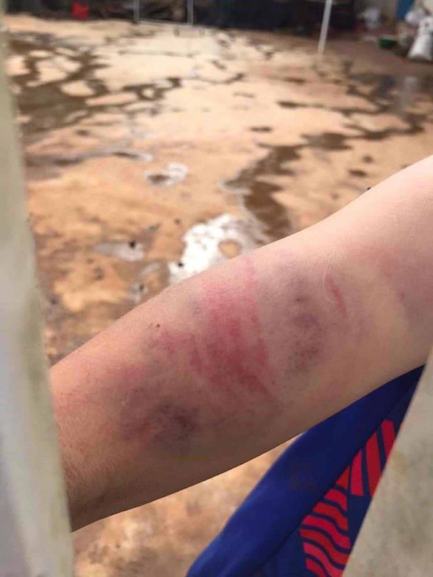 Cánh tay cháu A. bị bầm tím. Ảnh gia đình cung cấp