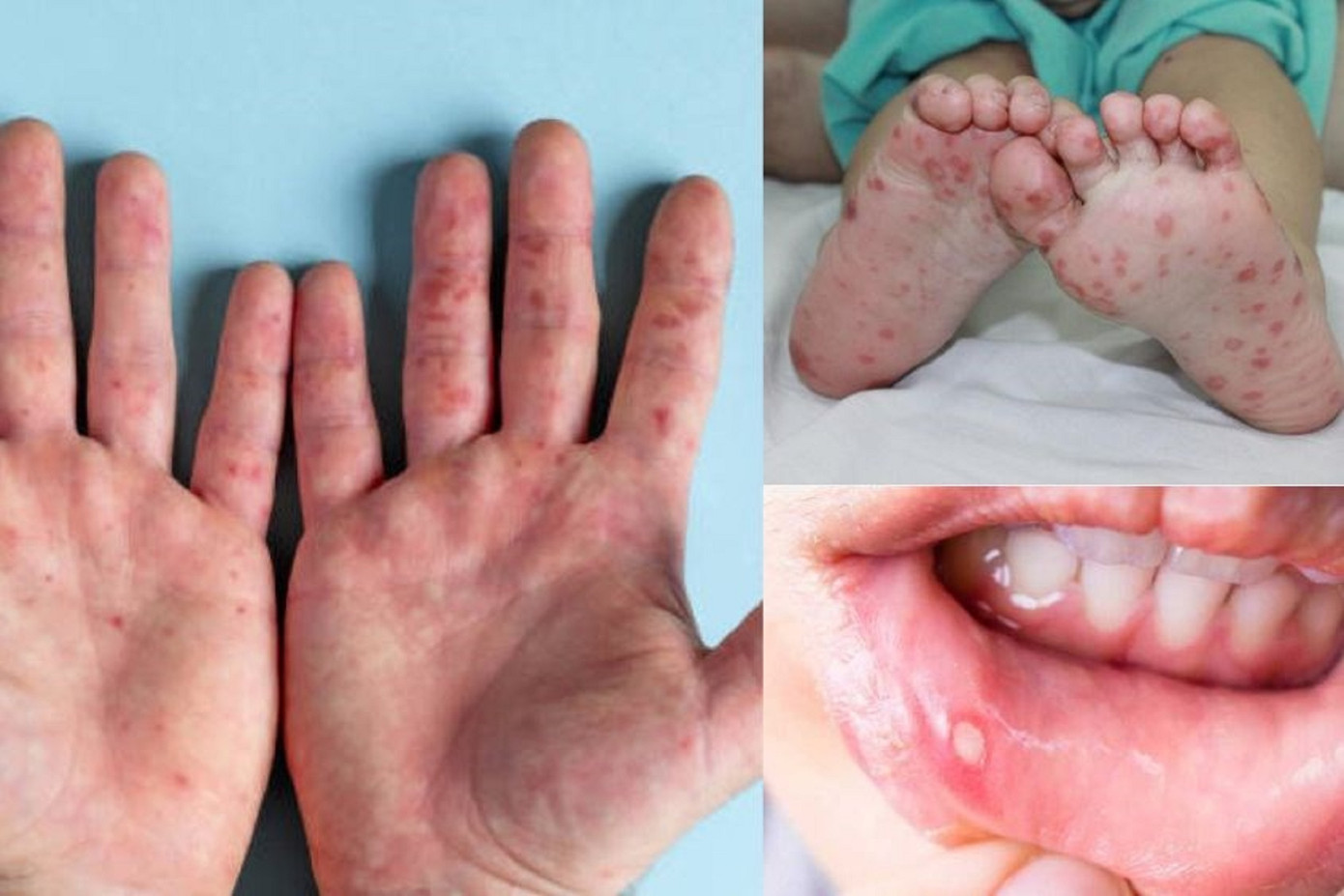 Đắk Lắk ghi nhận thêm 1 trường hợp tử vong vì bệnh tay chân miệng. Ảnh minh họa Đắk Lắk ghi nhận thêm 1 trường hợp tử vong vì bệnh tay chân miệng. Ảnh minh họa