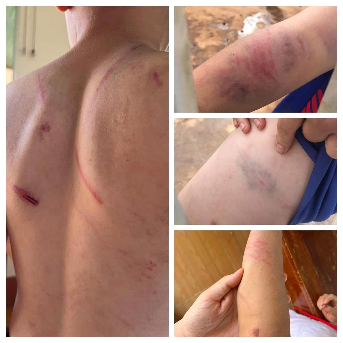 Các vết thương trên người cháu A. do gia đình bên ngoại chụp lại