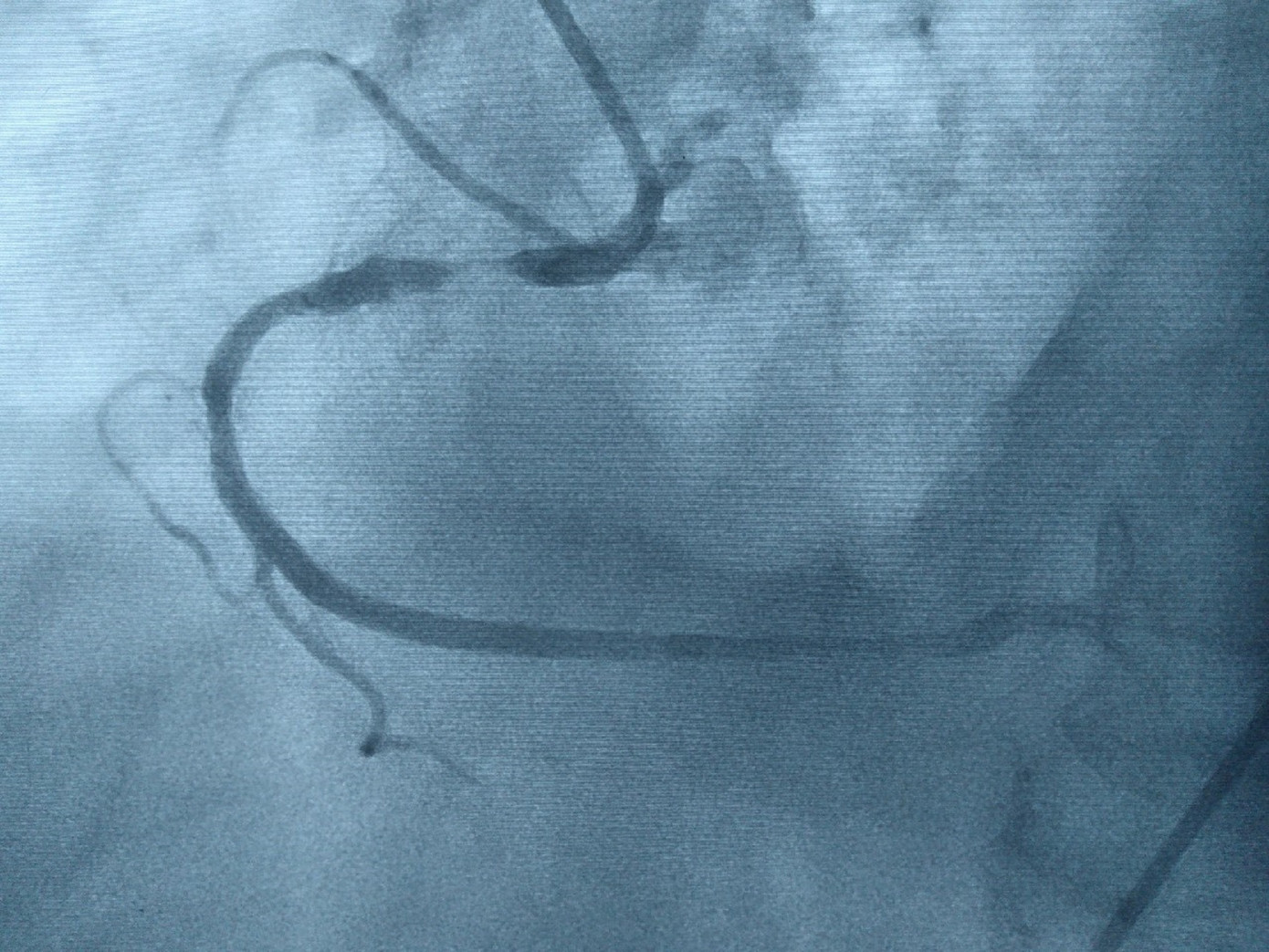 Hình ảnh động mạch vành bị hẹp nặng Hình ảnh động mạch vành bị hẹp nặng