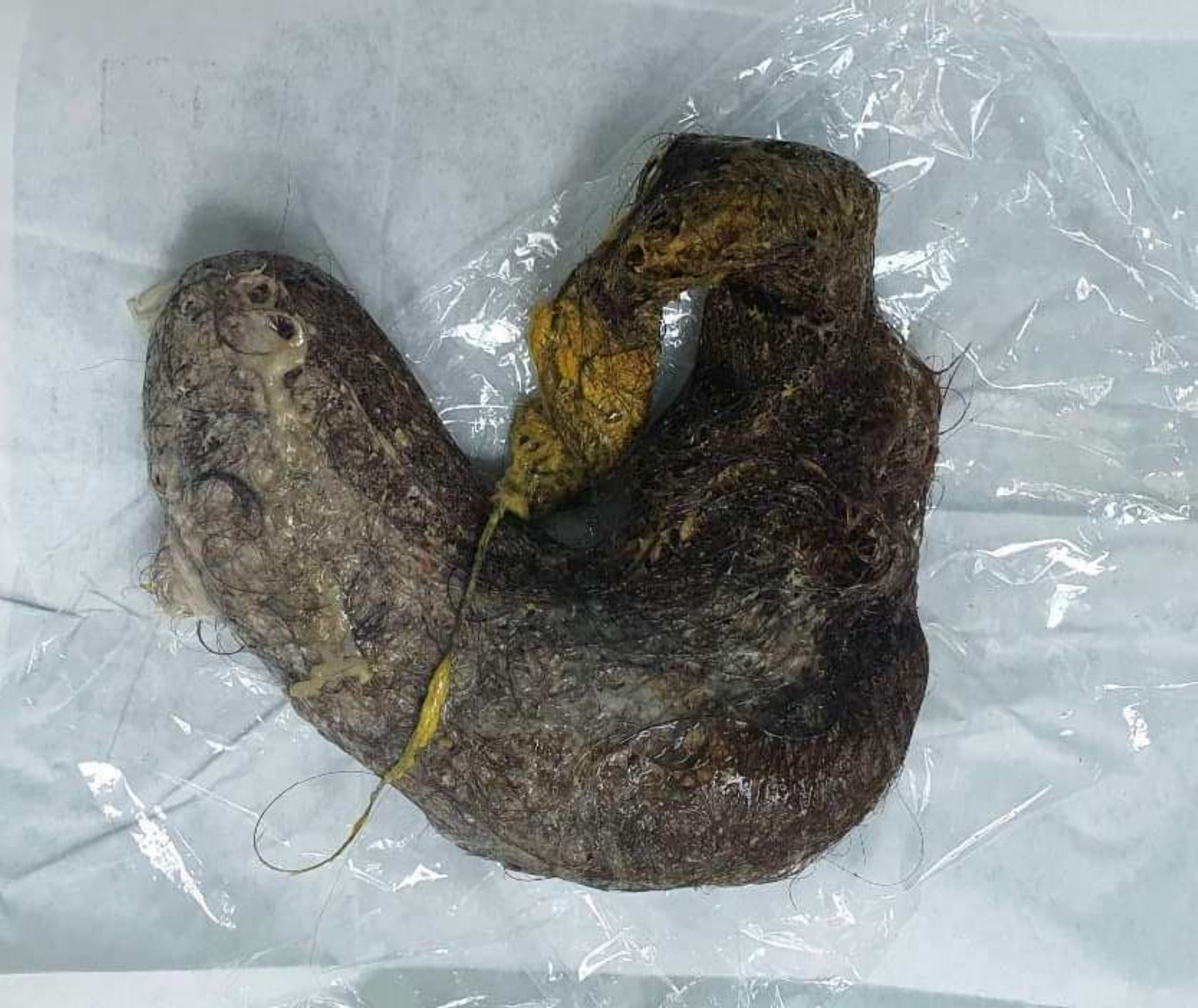 Búi tóc được lấy ra từ trong bụng bé gái Búi tóc được lấy ra từ trong bụng bé gái