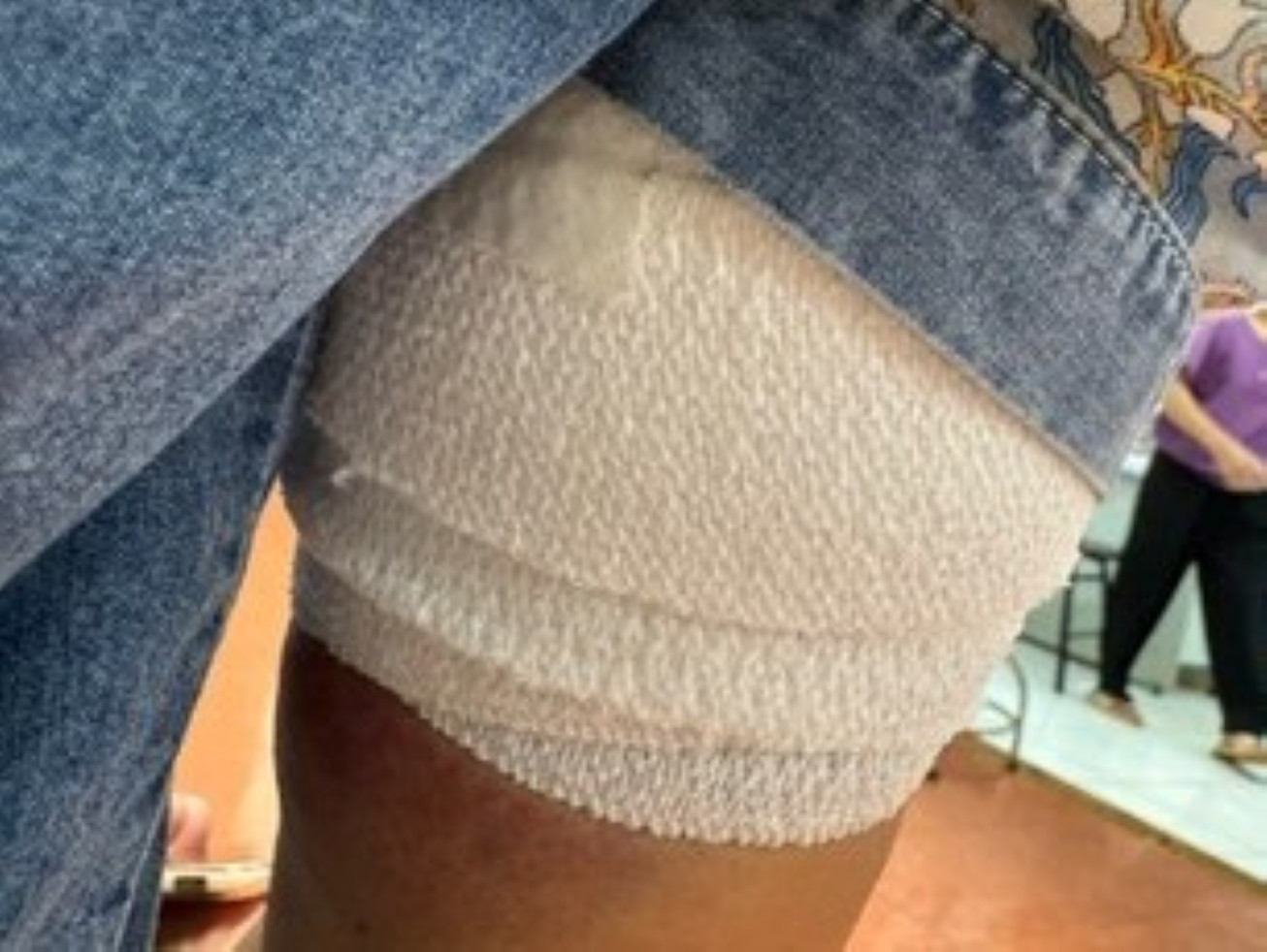 Một trường hợp bị thương do chó cắn