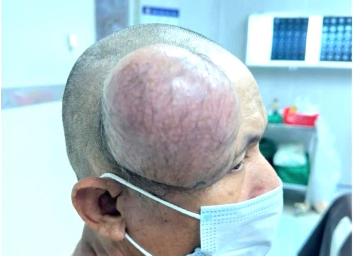 Khối u to như cái chén trên đầu bệnh nhân