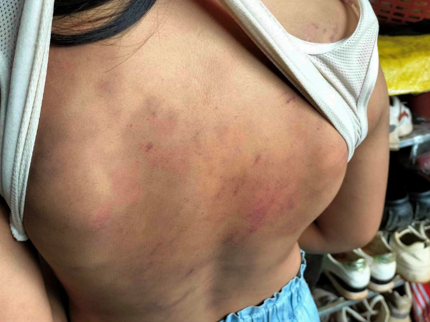 Phía lưng em U. bị bầm tím Phía lưng em U. bị bầm tím