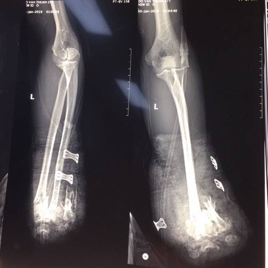 Hơn 3.400 trường hợp nhập viện do đánh nhau trong 5 ngày Tết ảnh 1