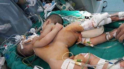 Các bé được đưa lên bàn mổ