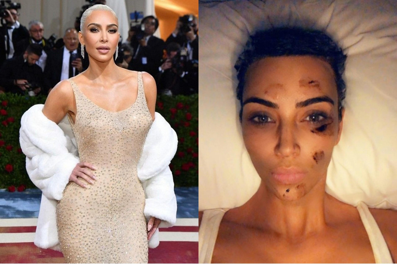 Kim Kardashian tái phát bệnh vảy nến vì giảm tới 7kg trong 3 tuần. Kim Kardashian tái phát bệnh vảy nến vì giảm tới 7kg trong 3 tuần.