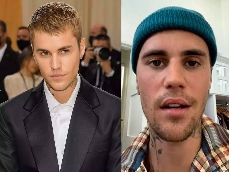 Một bên mặt của Justin Bieber bị liệt do virus.