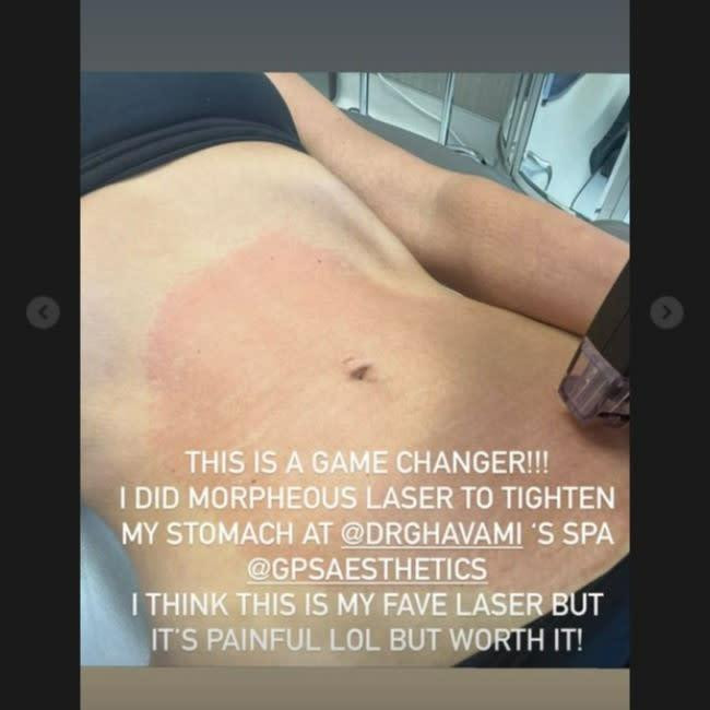 Kim Kardashian hào hứng lăng xê biện pháp sử dụng tia laser làm thon gọn vòng 2. Kim Kardashian hào hứng lăng xê biện pháp sử dụng tia laser làm thon gọn vòng 2.