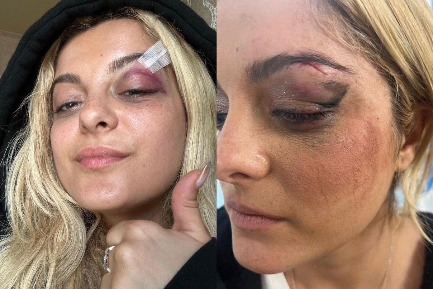 Bebe Rexha phải khâu 3 mũi trên mặt và hiện tạm ngừng tour diễn. Bebe Rexha phải khâu 3 mũi trên mặt và hiện tạm ngừng tour diễn.