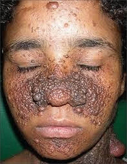  Angiofibroma là một nhóm các tổn thương bao gồm mụn da cây xơ, angiofibroma mặt, u tuyến sebaceum, xơ periungual, và khối u Koenen