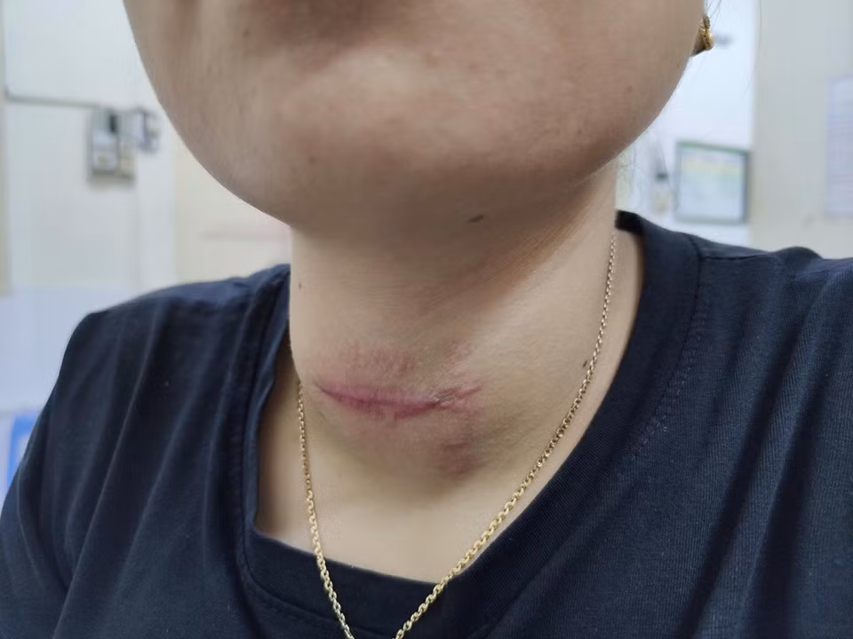 'Nát cổ' vì để thầy lang Hải Phòng chữa bướu cổ bằng châm hương và bôi keo ảnh 1