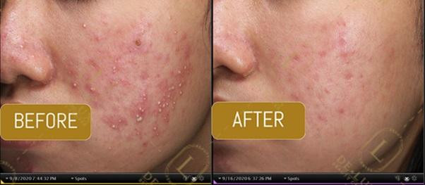 Hình ảnh Trước – sau khi điều trị mụn tại Lux Beauty Center