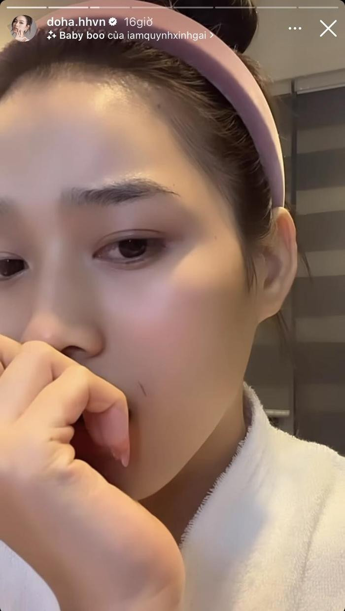 Đỗ Thị Hà lỡ tay cứa vào mặt khi đang mải làm đẹp.