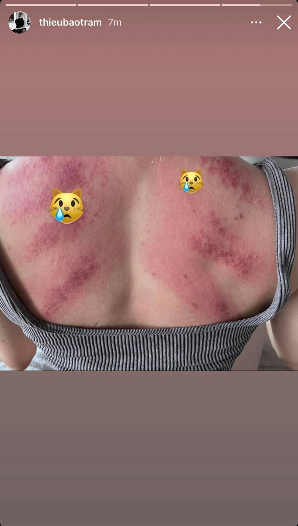 Hình ảnh gây lo lắng của Thiều Bảo Trâm.