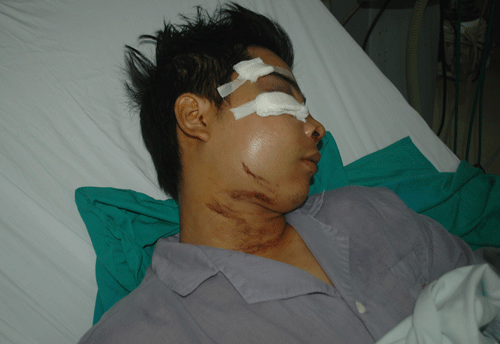 Hoàng sau ca phẫu thuật - Ảnh: Hà An (Thanh Niên)