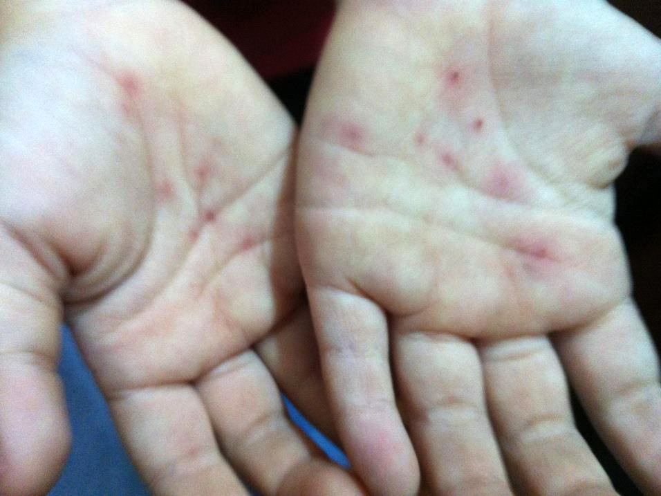 Bàn tay của cháu Vương Gia Huệ với vết thương do vật nhọn đâm vào. Ảnh do gia đình cung cấp