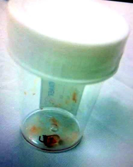 Nuốt bóng đèn LED, bé trai 6 tuổi phải cắt bỏ một phần phổi ảnh 2