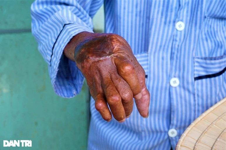 Tay của ông Ngọc bị thương trong chiến tranh, mỗi khi trái gió trở trời thì rất đau nhức. Tay của ông Ngọc bị thương trong chiến tranh, mỗi khi trái gió trở trời thì rất đau nhức.
