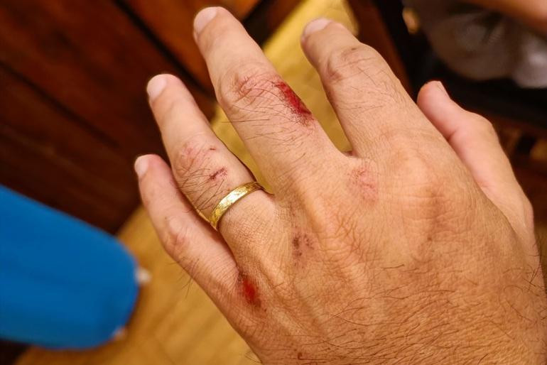 Anh Lâm bị thương, phải uống thuốc phơi nhiễm HIV sau khi bắt cướp. Ảnh: Nhân vật cung cấp. Anh Lâm bị thương, phải uống thuốc phơi nhiễm HIV sau khi bắt cướp. Ảnh: Nhân vật cung cấp.