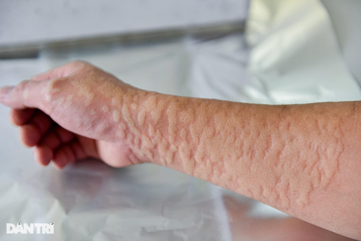 Sau mỗi lần cho muỗi ăn, tay của anh Hùng lại bỏng rát, chi chít các vết phồng rộp.