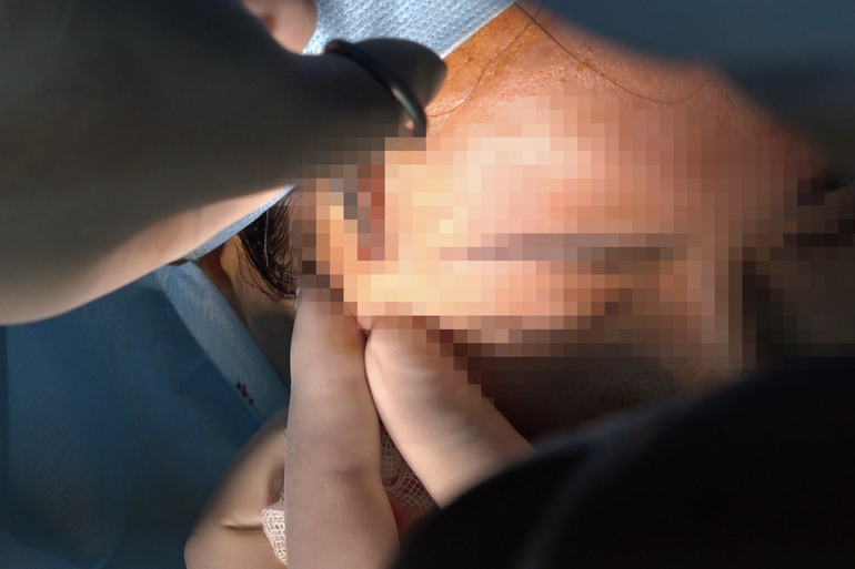 Một trường hợp biến chứng nặng sau khi tiêm filler ở mặt. Ảnh: BVCC.